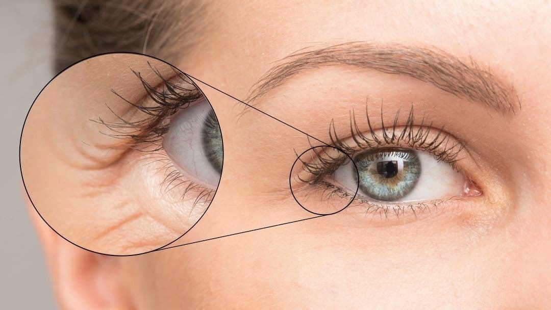 woman eye wrinkles